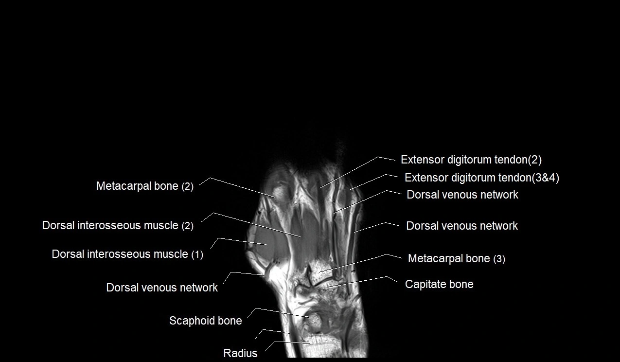 MRI 3T coronal hand cross sectional anatomy image 15.webp